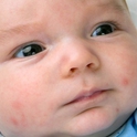 Аллергия у новорожденных...